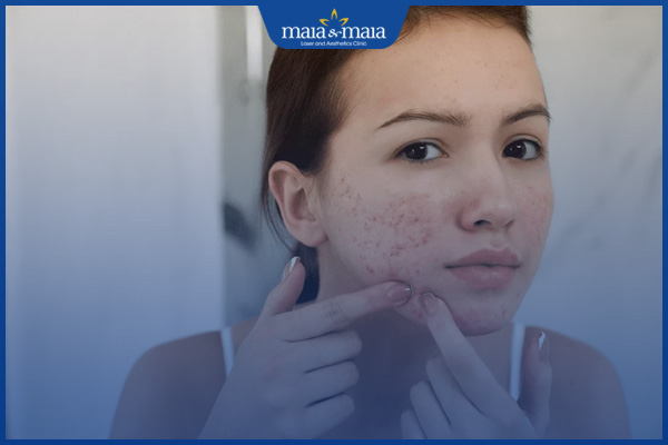lấy nhân mụn trứng cá