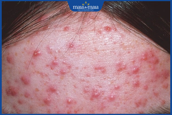 mọc mụn trứng cá ở trán