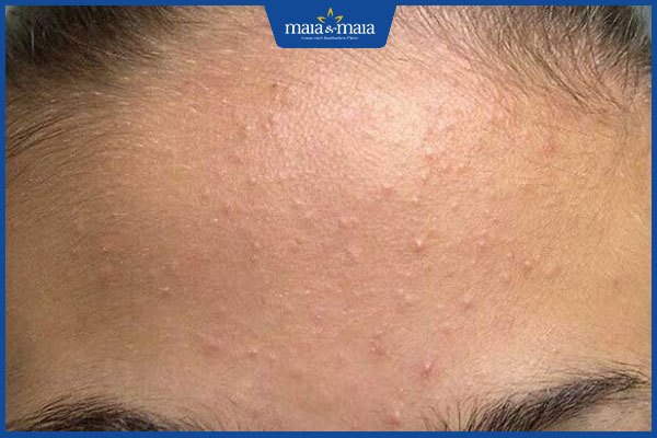 mụn ẩn trên trán