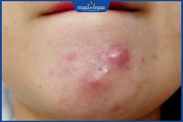 mụn trứng cá bọc
