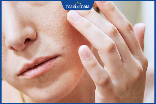 mụn trứng cá mủ gây ngứa