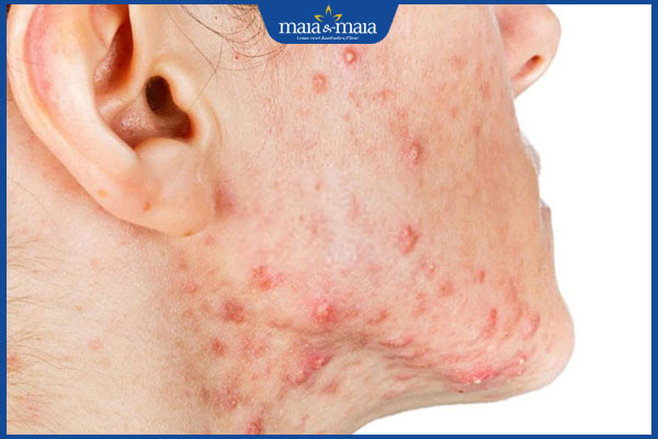 mụn trứng cá mủ quanh mắt