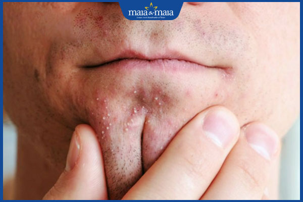 mụn trứng cá ở cằm