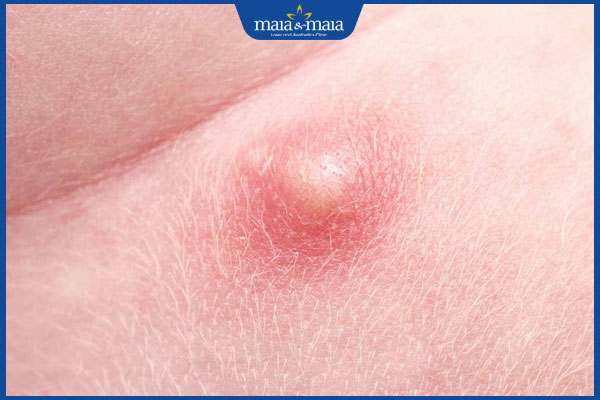 mụn trứng cá ở mông