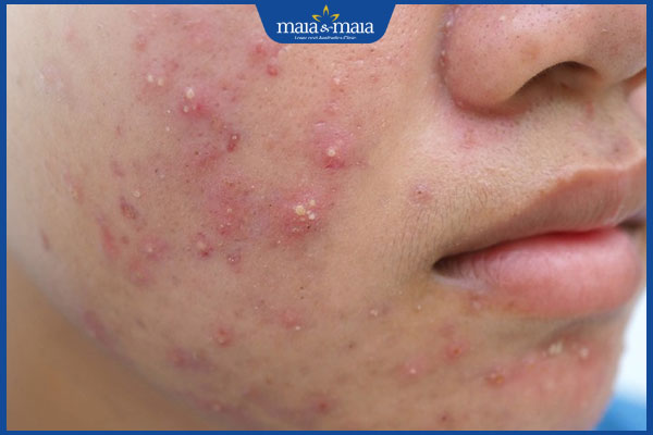 mụn trứng cá ở tuổi dậy thì
