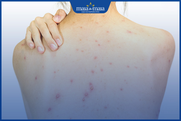 mụn trứng cá ở vùng lưng