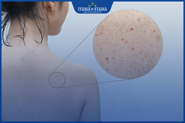 nổi mụn trứng cá ở lưng