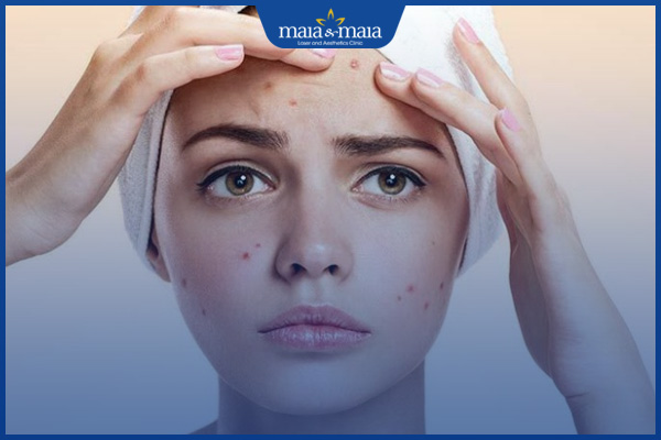 thói quen mọc mụn ở trán
