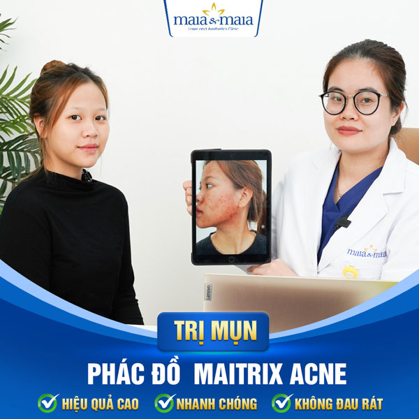 trị mụn trứng cá thành công