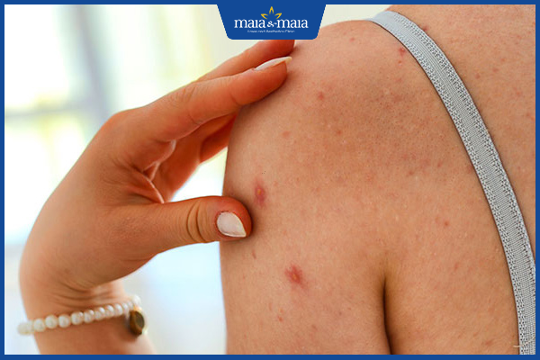 biểu hiện mụn trứng cá ở tay