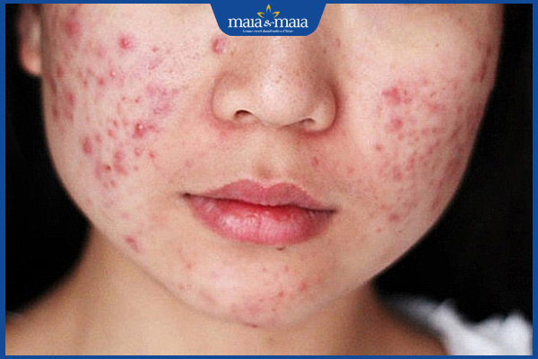 biểu hiện mụn trứng cá trên da
