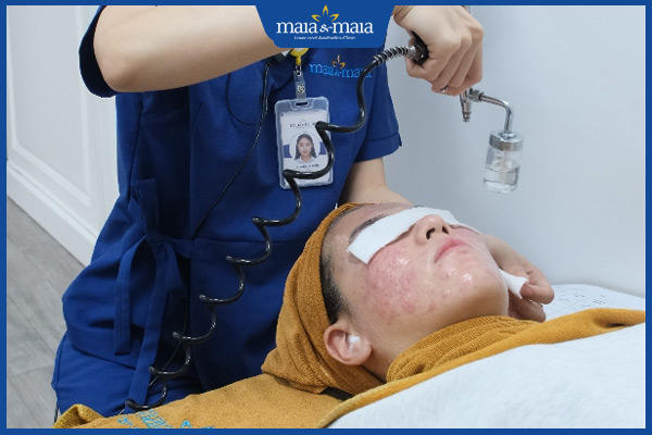 cách thay thế trị mụn ẩn