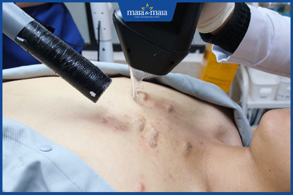 chọn địa chỉ xóa sẹo