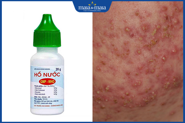 công dụng trị mụn của hồ nước