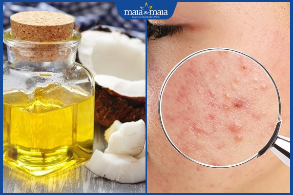 dầu dừa trị mụn ẩn