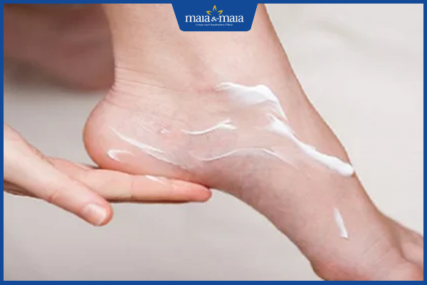 điều trị mụn nước chân tại nhà
