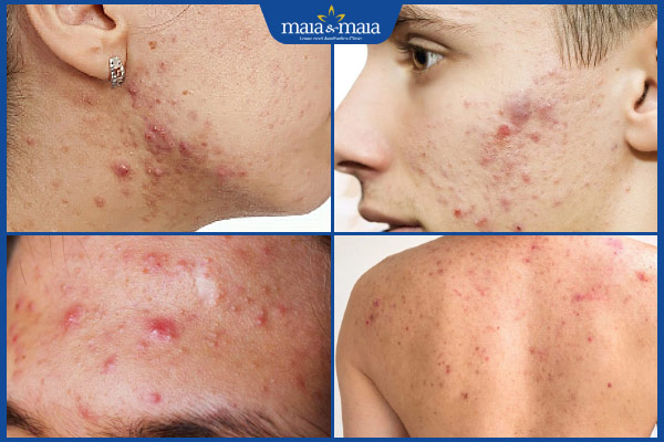 đối tượng trị mụn trứng cá bằng laser