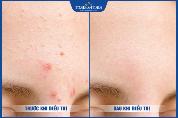 hiệu quả điều trị mụn ẩn
