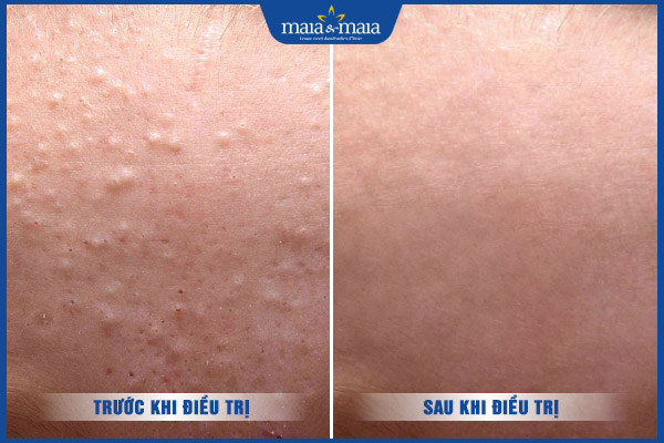 hiệu quả sau khi trị mụn ẩn
