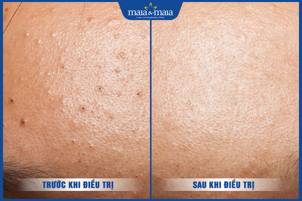 hiệu quả sau trị mụn ẩn