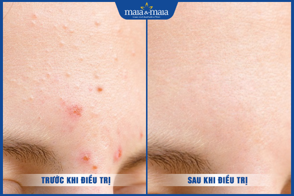 hiệu quả trị liệu