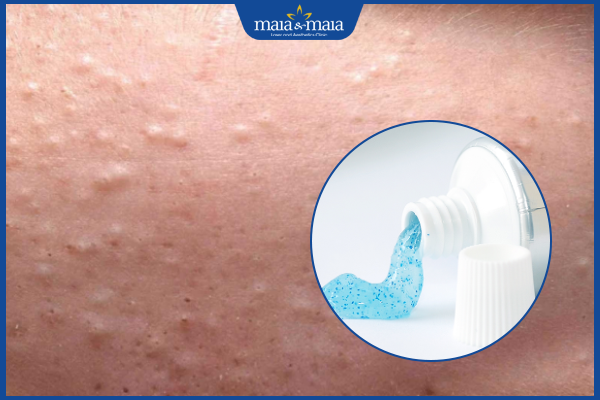 kem đánh răng trị mụn ẩn