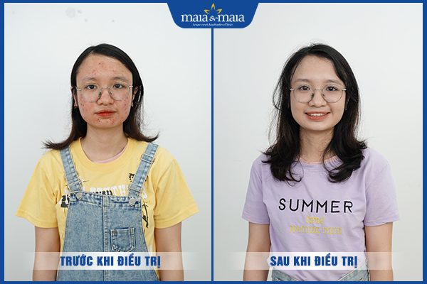 kết quả trị mụn ẩn