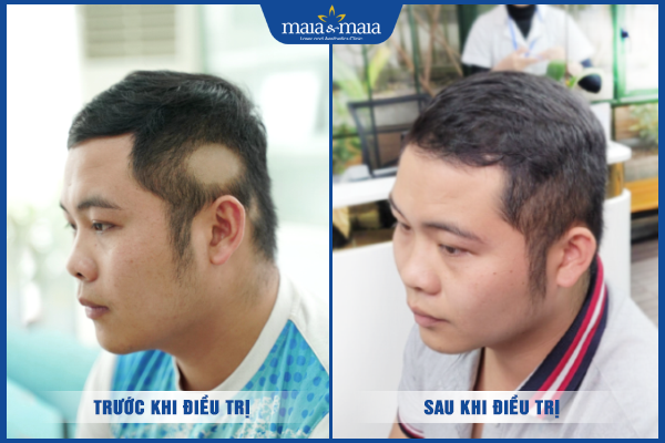 kết quả trị rụng tóc