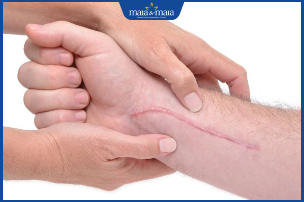 kiêng khem tránh sẹo lồi