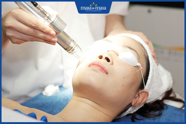 laser co2 trị mụn ẩn