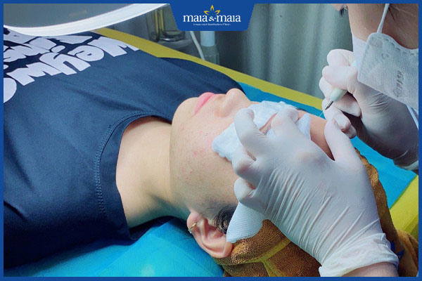 laser trị mụn trứng cá