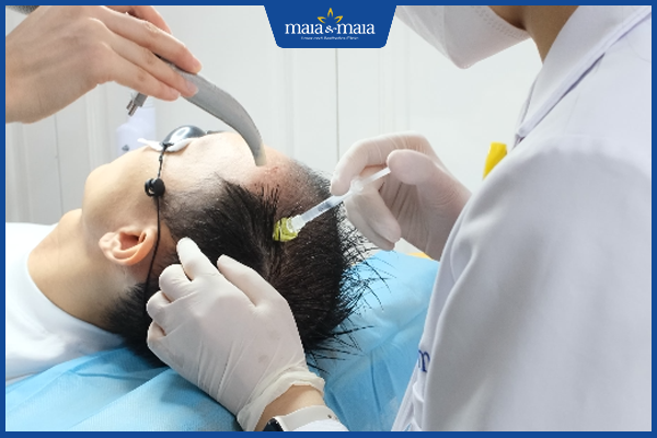 liệu pháp trị rụng tóc