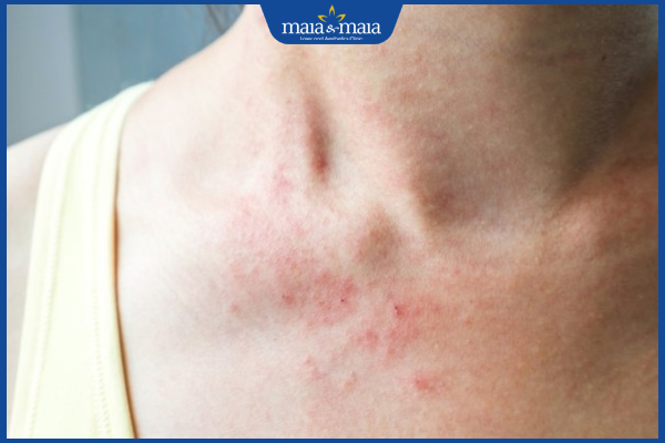 mụn nước gây rôm sẩy