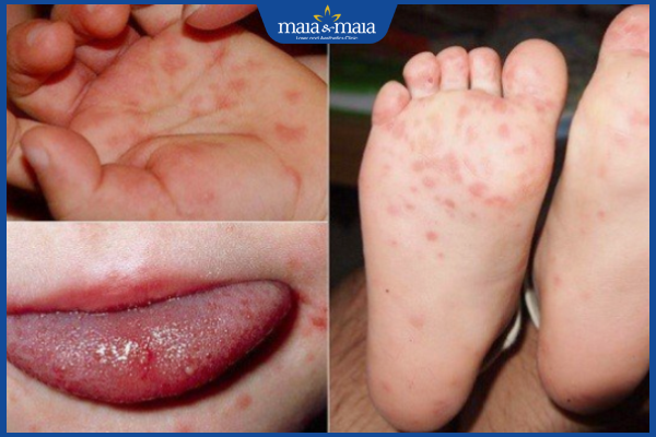 mụn nước tay chân miệng