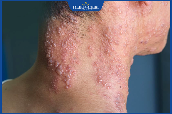 mụn nước zona thần kinh