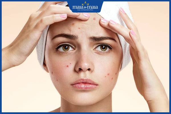 mụn trứng cá đối xứng
