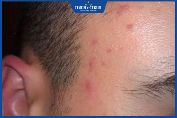 mụn trứng cá thái dương nhẹ