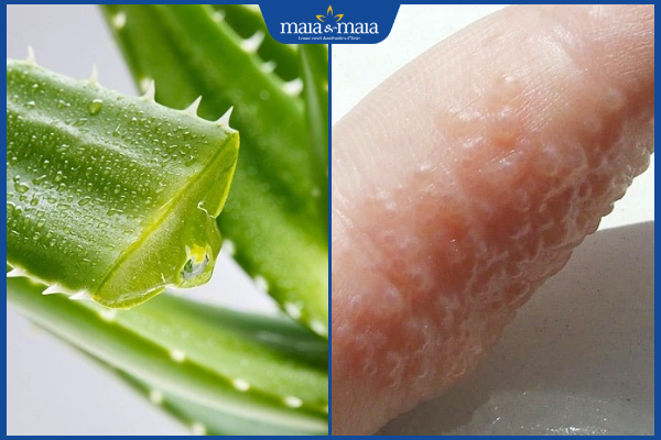 nha đam trị mụn nước ở trẻ