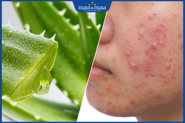 nha đam trị phát ban mụn trứng cá