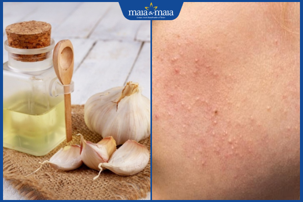 nước ép tỏi trị mụn ẩn