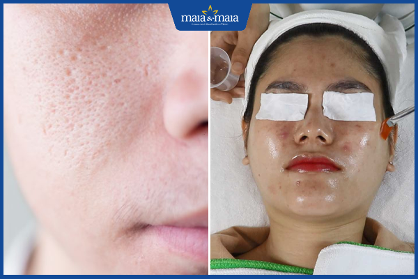 peel da trị mụn ẩn tại nhà
