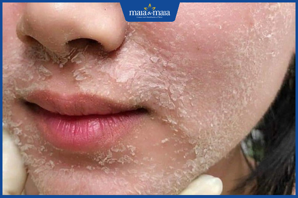 peel da trị mụn ẩn