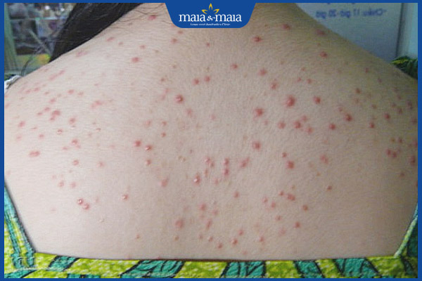 phát ban mụn trứng cá ở lưng