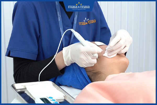 phương pháp trị dứt điểm mụn ẩn