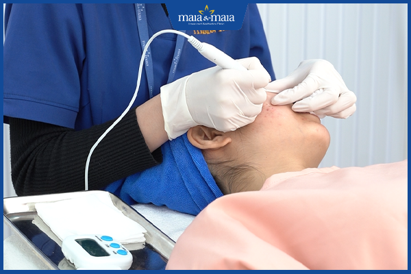 phương pháp trị mụn an toàn