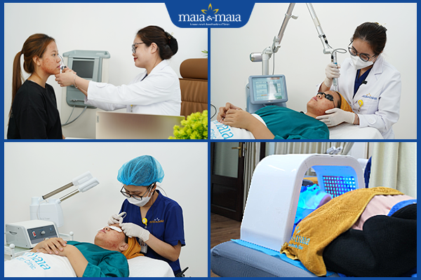 quy trình trị mụn ẩn quanh miệng