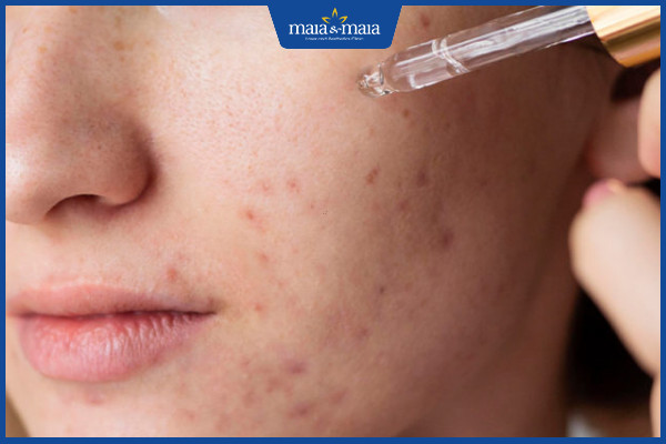 retinol trị mụn ẩn