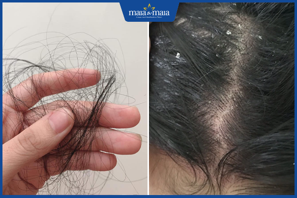 tóc rụng nhiều gàu