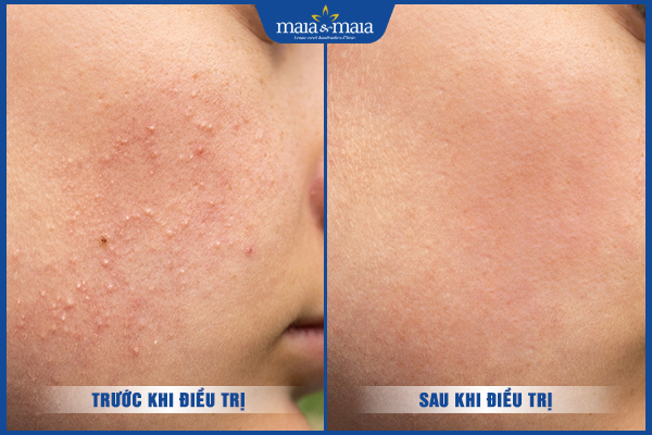 trị mụn ẩn hiệu quả