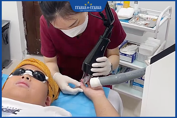 trị mụn nước tại maia